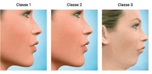 Cirurgia Ortognática Classes