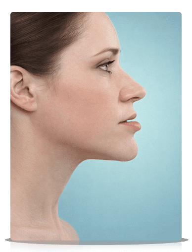 Ortognática Classe 3